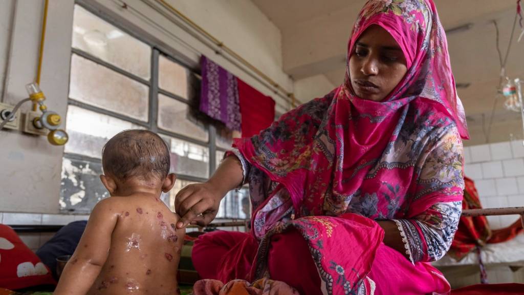 Bangladeshda qizamiq kasalligi tobora avj olmoqda